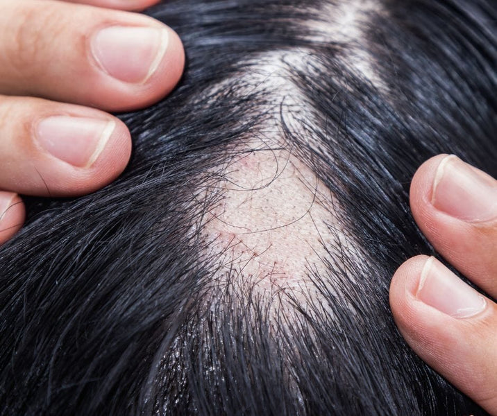 Understanding Hair Loss: Causes, Symptoms, and Natural Remedies