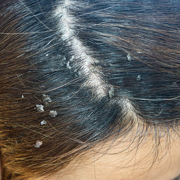 Soothe and Shine: Effective Scalp Psoriasis Treatment